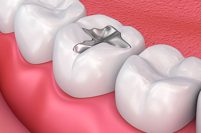 Steven E. Marek, DDS, LTD | Crowns  amp  Caps, Veneers and Dental Bridges