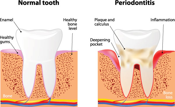 Steven E. Marek, DDS, LTD | Periodontal Treatment, Dental Cleanings and Dental Fillings