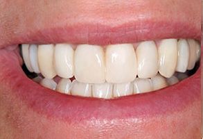 Steven E. Marek, DDS, LTD | Teeth Whitening, Root Canals and Cosmetic Dentistry