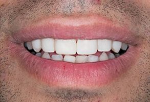 Steven E. Marek, DDS, LTD | Cosmetic Dentistry, Dental Bridges and Dentures