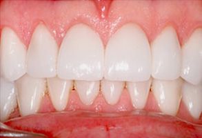 Steven E. Marek, DDS, LTD | Teeth Whitening, Emergency Treatment and Dentures