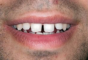 Steven E. Marek, DDS, LTD | Dentures, Crowns  amp  Caps and Root Canals